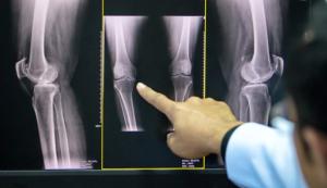 Osteoporoz (Kemik Erimesi) Nedir? Tanı,Koruma, Ve Tedavisi Nasıldır?